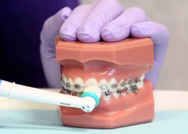 戴了牙套怎么使用電動(dòng)牙刷？正確使用牙刷很重要